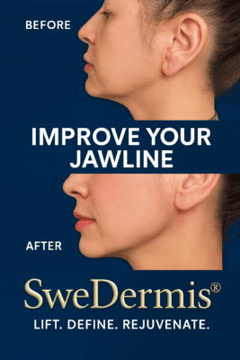 SweDermis Dermal Filler Sweden